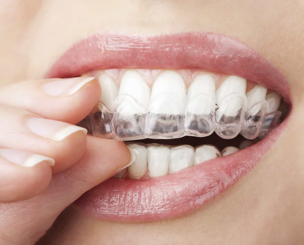 Invisalign Milano Due - Ortodonzia invisibile