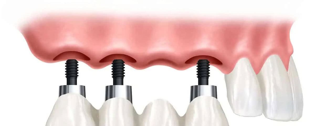 implantologia quattro