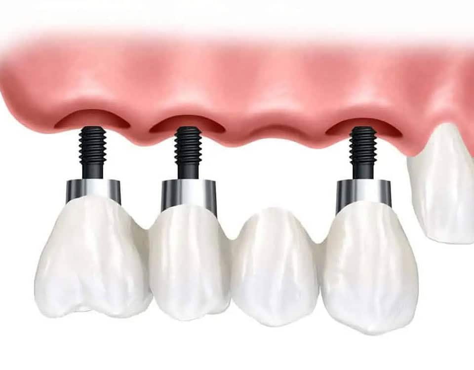 implantologia quattro